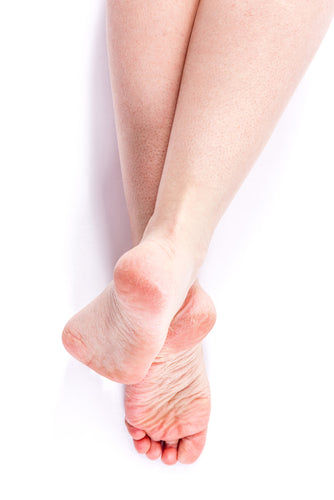 person with dry heels in need of a foot crack solution